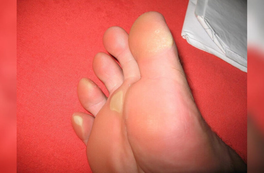 Нове взуття залишає мозолі: чотири&hellip;